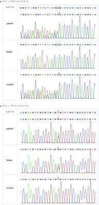 Citrullinemia type I in Chinese children: Identification of two novel argininosuccinate synthetase gene mutations